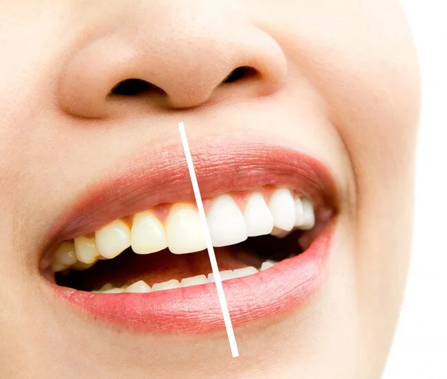 دانت سفید کرنے کا طریقہ - اب مسکرائیں کھل کر