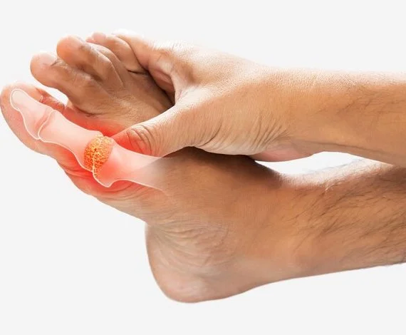 یہ تصویر یورک ایسڈ کی ہے جس کا مکمل علاج نہایت ضروری ہے۔