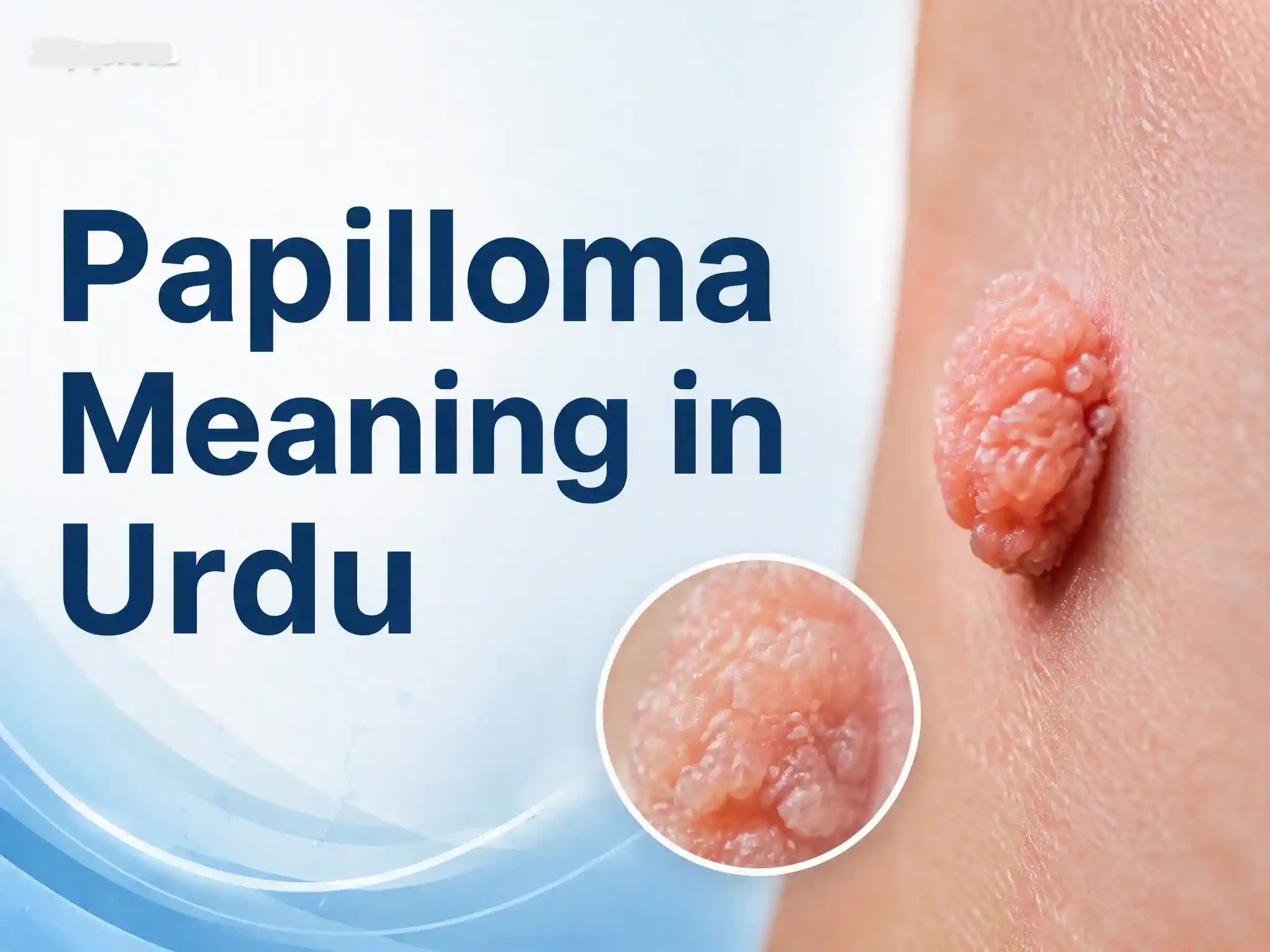 Papilloma can appear anywhere on skin.